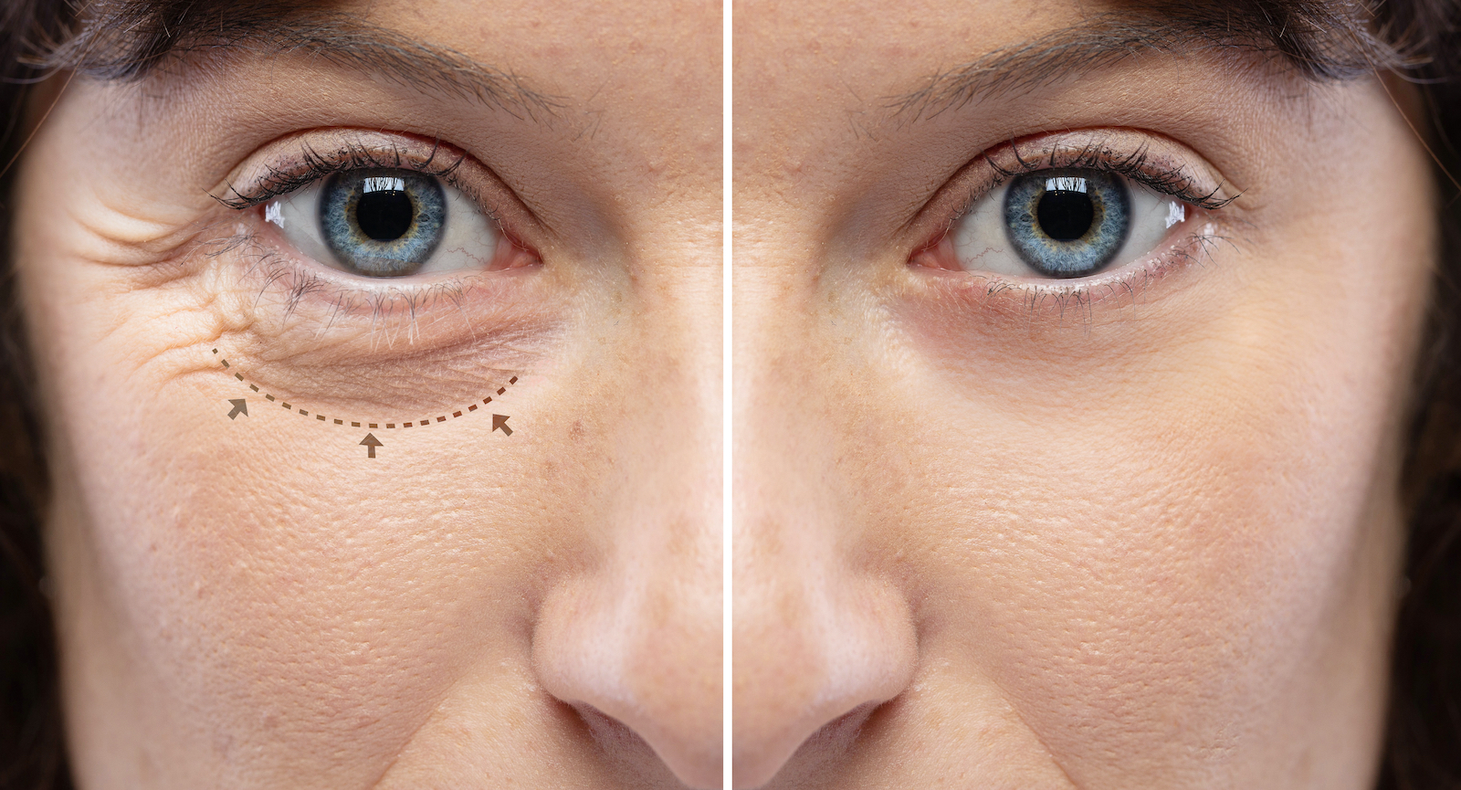 Cosmetic Procedures Waterville Eye Care of Maine Farmington